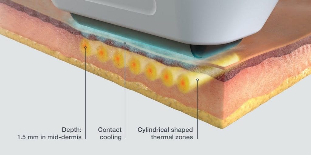 Sofwave Technology