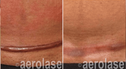 Laser Scar Removal, Before & After